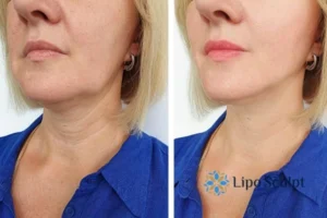 Double chin before and after Hi-Fu treatment 4 Book your double chin treatment Ashford today! We are here to help!