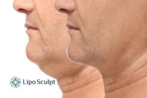 Double chin before and after Hi-Fu treatment 2 Double chin treatment Ashford from Lipo Sculpt - feel more confident today!