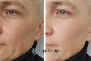 How to Fight Aging Symptoms 3 Fight Aging Symptoms Ashford With HIFU and Morpheus8 Today!
