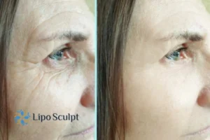 How to Fight Aging Symptoms 2 Do you want to Fight Aging Symptoms Ashford? Contact Lipo Sculpt today!
