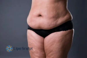 Cellulite's 5 Most Common Causes 4 Feel more confidence with your cellulite Ashford treatment today!
