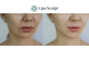 Explaining Total Skin Tightening Treatment And What It Can Do For You 2 Do you want to boost your self confidence? Give Morpheus8 Ashford a try today!