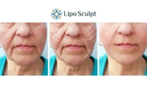 Explaining Total Skin Tightening Treatment And What It Can Do For You 3 Boost your confidence with Morpheus8 Ashford call our team today!