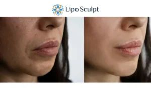 Explaining Total Skin Tightening Treatment And What It Can Do For You 4 Morpheus8 Ashford the best results - call our team today!