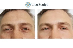 Explaining Total Skin Tightening Treatment And What It Can Do For You 6 Morpheus8 Ashford book in today to find out more!