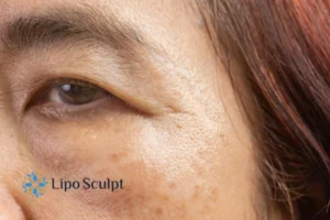 Cryopen: The Revolutionary Treatment for Age Spots Unveiled 2 Are age spots Ashford giving you low self esteem? Contact us today!