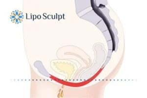Pelvic Floor Chair Therapy 1 Pelvic Floor Chair Therapy Ashford to treat incontinence.