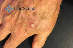 Best Actinic Keratoses Removal 2 Improve your wellbeing and health with Actinic Keratoses Ashford removal.treatment